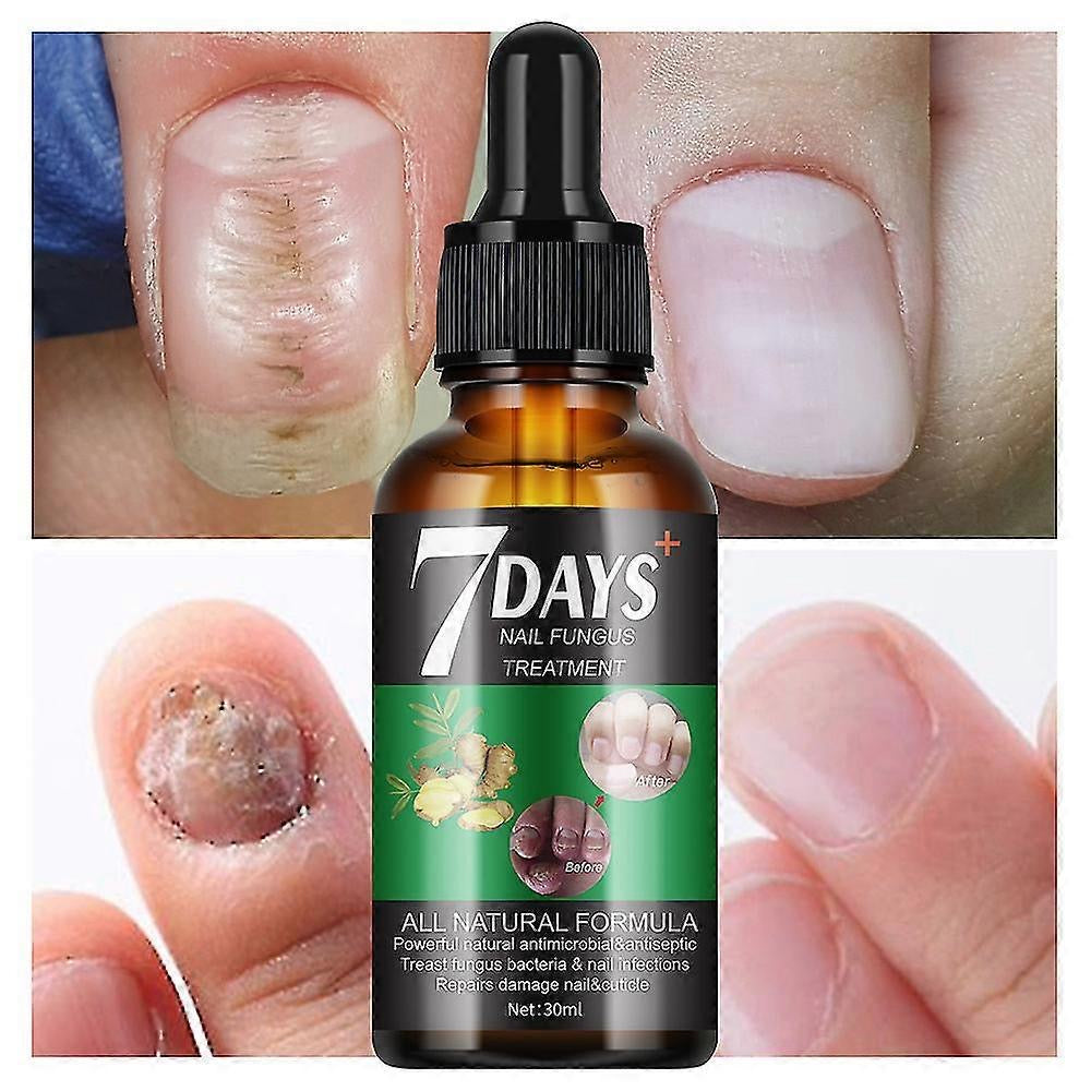 Anti-Mycoses des Ongles Naturel  ( Résultat en 7jours )